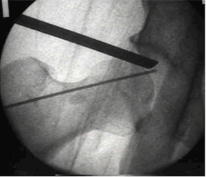 hip arthrscopy.jpg (300&times;258)