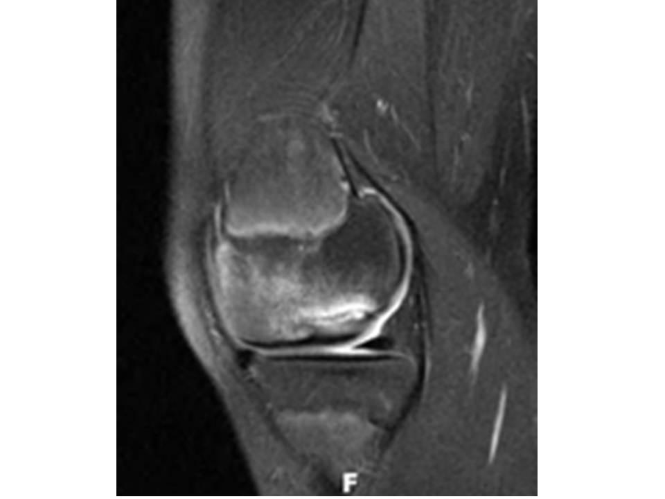 Osteochondritis Dissecans Sports