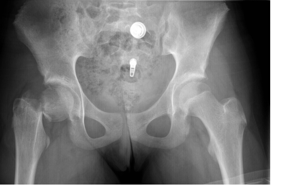 nondisplaced subcapital femoral neck fracture