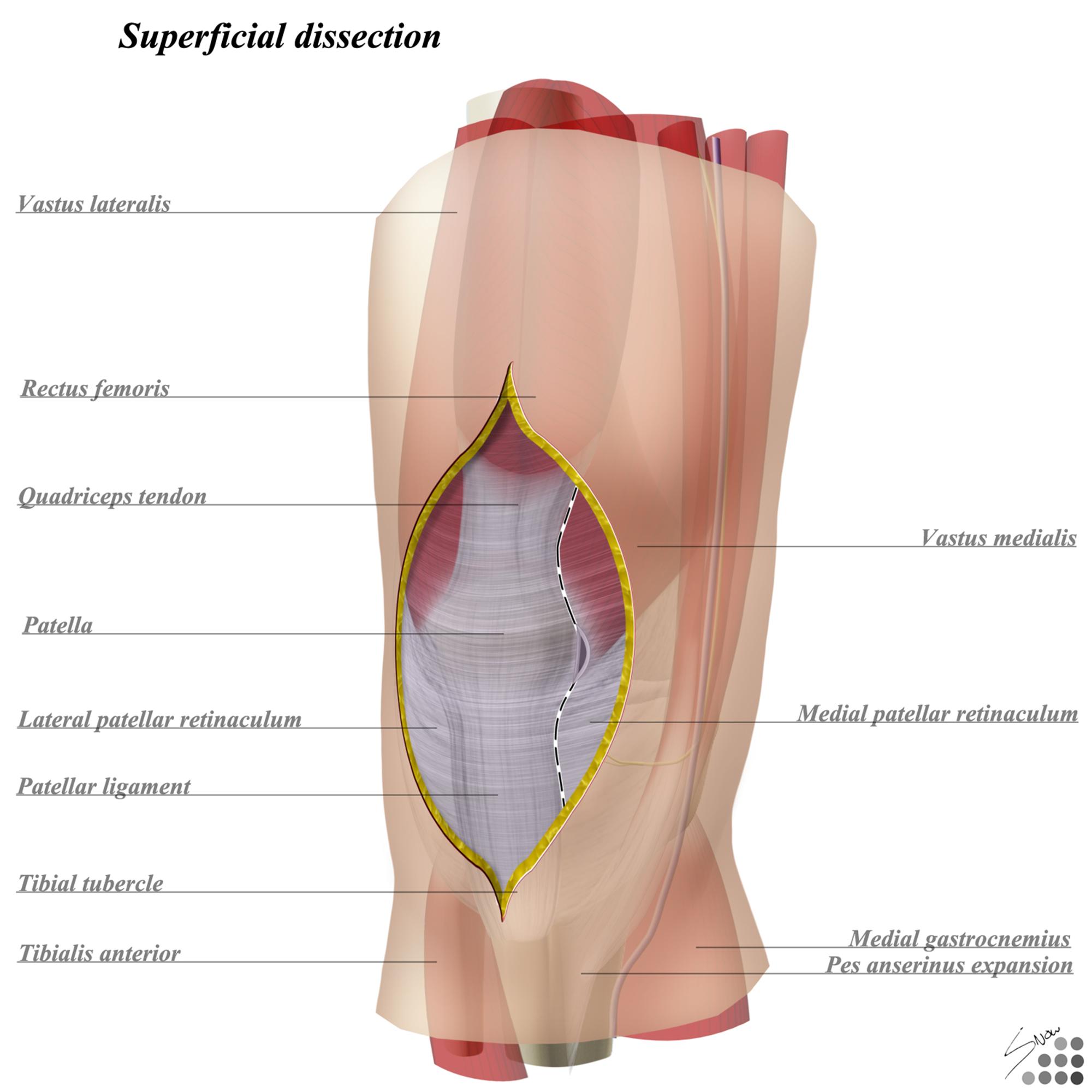 Arthrotomy Elbow