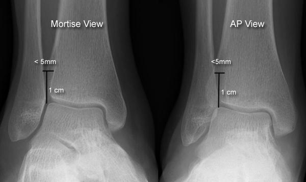 High Ankle Sprain Syndesmosis Injury Foot Ankle Medbullets Step 1