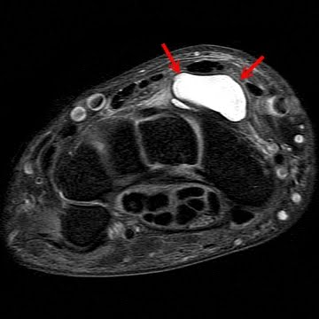 Tratamentul chisturilor articulare