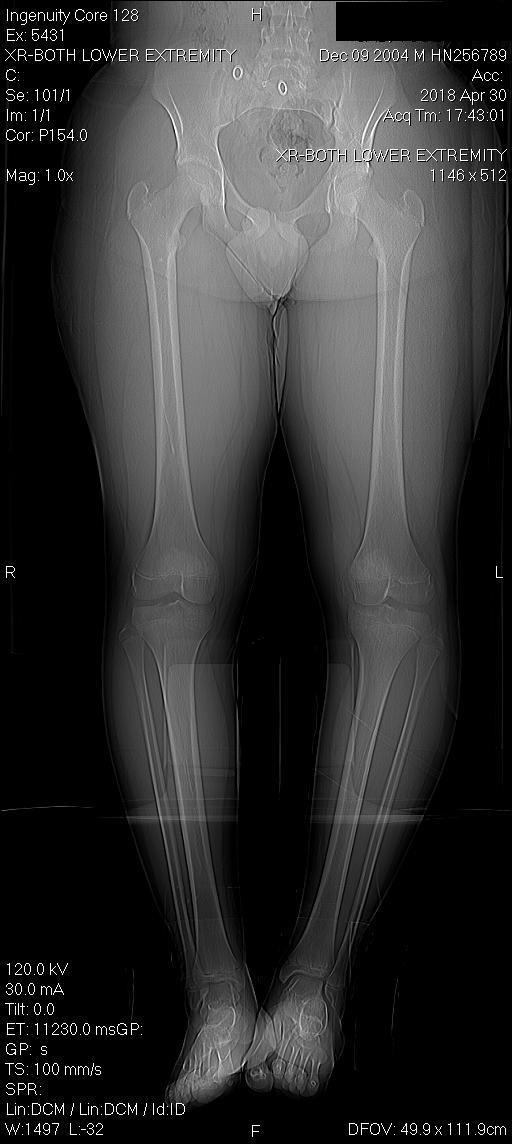Accessory Navicular Pediatrics Orthobullets