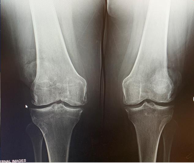 TKA Coronal Plane Balancing Recon Orthobullets