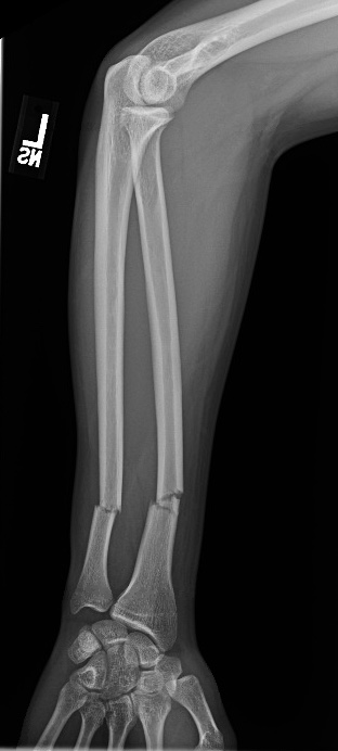 https://upload.orthobullets.com/cases/101479/15a0686a-8f64-4119-a39c-2f3b0db8a5a5_injury_ap..jpg