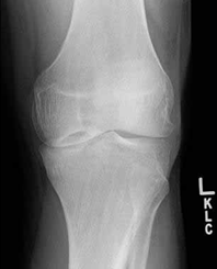 Osteochondritis Dissecans - Knee & Sports - Orthobullets