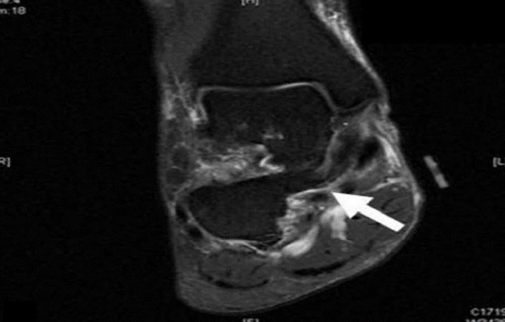 https://upload.orthobullets.com/cases/101502/25fc55bd-8a17-43d1-afde-a01a5ef25e93_coronal_mri.jpg