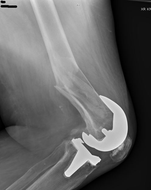 https://upload.orthobullets.com/cases/101537/63b6d618-883e-4c36-a8fb-3e442c7440d2_2.jpg
