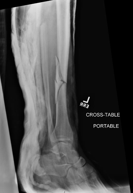 https://upload.orthobullets.com/cases/101710/15d091ea-1ff1-4651-8f25-3bada464361f_left_preop2.jpg