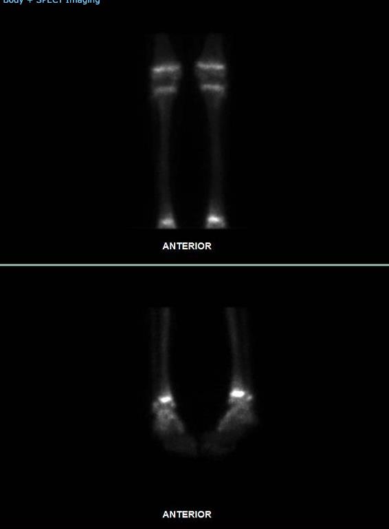 https://upload.orthobullets.com/cases/101816/3324d962-f58c-46fa-9720-163be0e5fc76_bone_scan.jpg