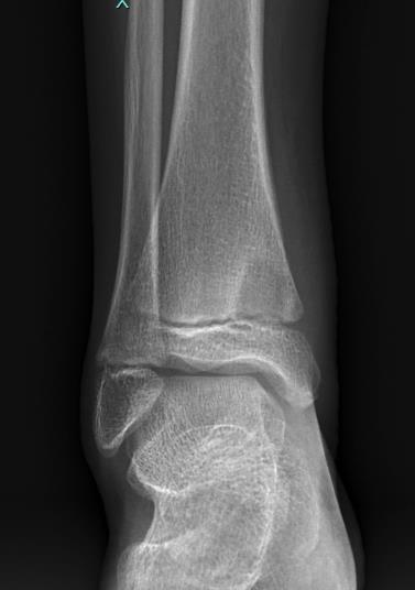 https://upload.orthobullets.com/cases/101816/3be30c6c-bf62-447d-adde-ee52103763a8_xr_r_ankle_ap.jpg