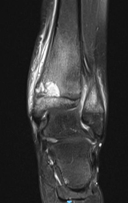 https://upload.orthobullets.com/cases/101816/a88591e2-22c6-435b-b7a8-982e1845f813_mri_coronal.jpg