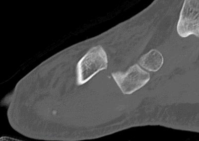 https://upload.orthobullets.com/cases/101882/11f6aa12-5cc5-436c-a05f-2358769f5882_sagittal_ct1.jpg