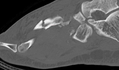 https://upload.orthobullets.com/cases/101882/b24bbaa9-6bba-4e5a-b0b8-7c6bb8e8c2f1_sagittal_ct4.jpg