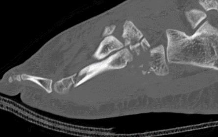 https://upload.orthobullets.com/cases/101882/f80bca9a-24ac-460f-9b72-eb1196c2f0f4_sagittal_ct5.jpg