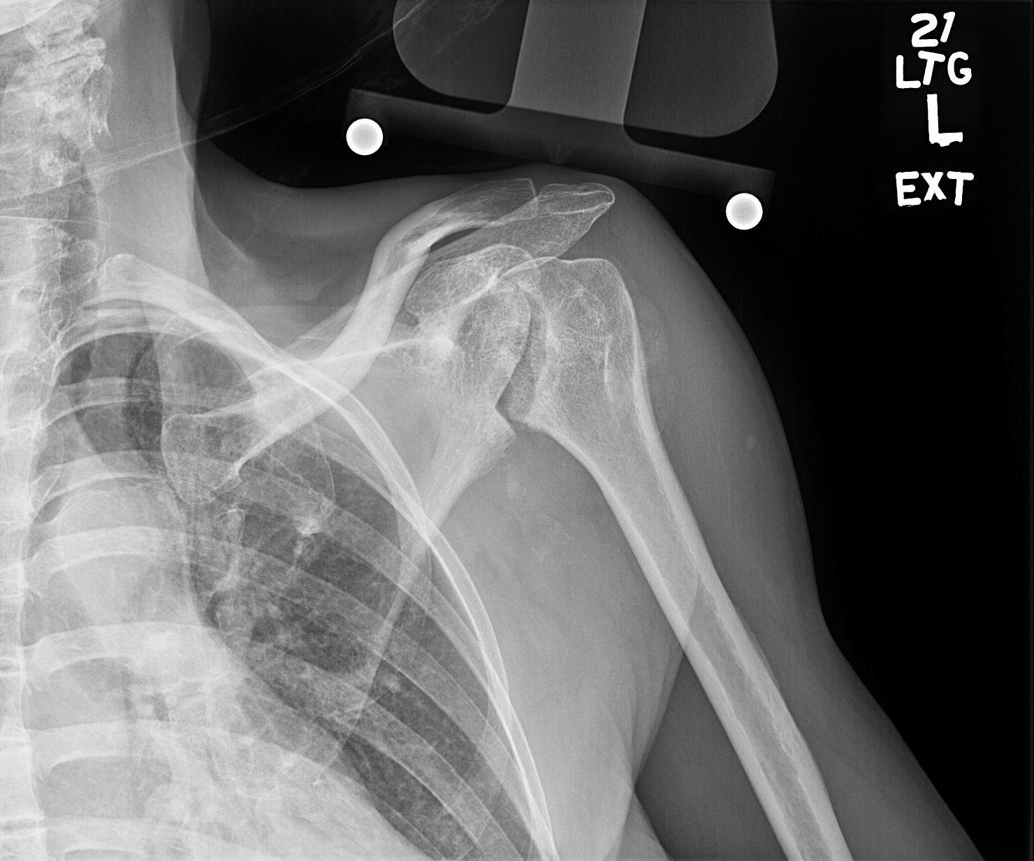 https://upload.orthobullets.com/cases/101924/e02a7137-d6b6-43a8-9f71-51ef99894dab_xray_ap_1.jpg