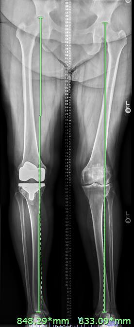 https://upload.orthobullets.com/cases/101934/eab59354-fe7f-45b6-8b2f-5cd9af8b4dca_preop_knee_oa_scanogram.jpg