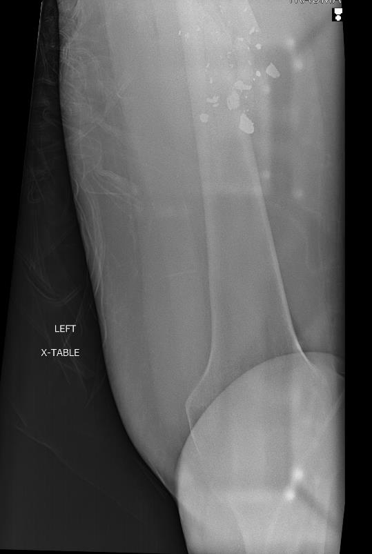 https://upload.orthobullets.com/cases/102003/ac3cbcaa-63a2-435e-bcd2-b75cc62cb6c0_capture4.jpg