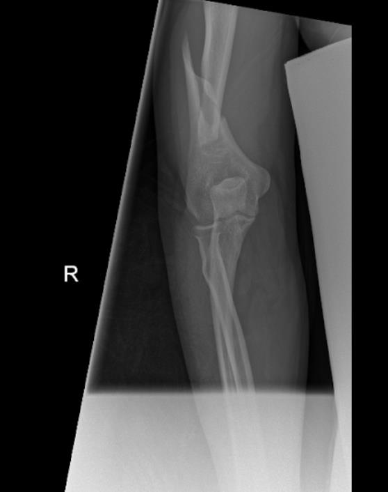 https://upload.orthobullets.com/cases/102067/b2301c70-fc88-4271-b541-86118465702b_fw2.jpg