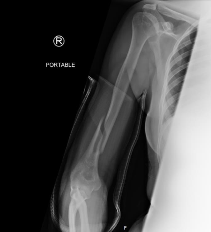 https://upload.orthobullets.com/cases/102067/bbce48f0-1f45-4487-8d69-c007328f8ed1_pr2.jpg