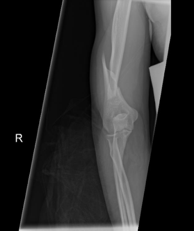 https://upload.orthobullets.com/cases/102067/c0531e52-8f8d-42ca-82b8-1d1bc7949f9f_fw5.jpg