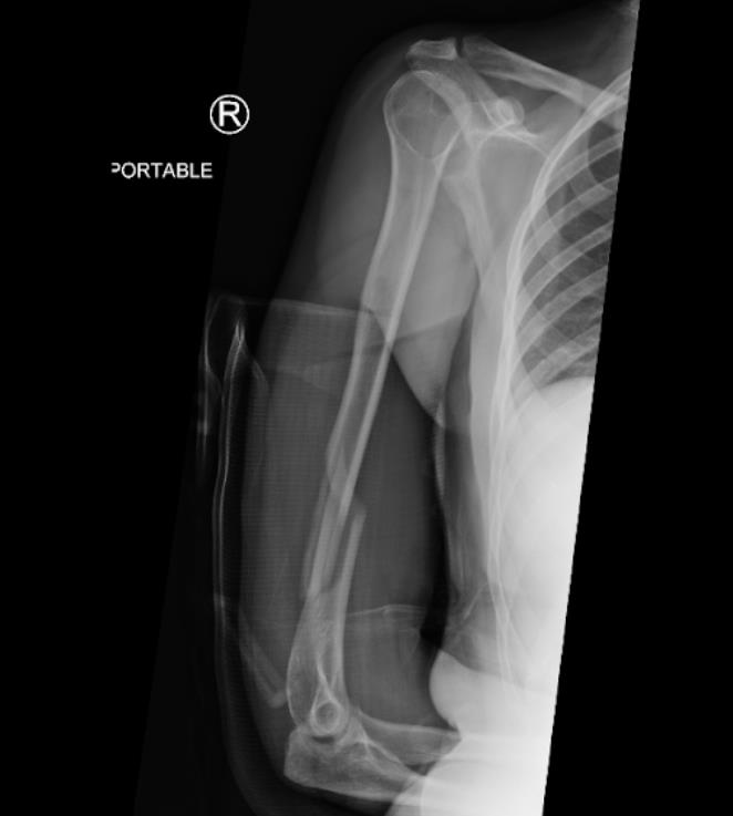 https://upload.orthobullets.com/cases/102067/e361c544-4c9f-4a64-9c27-0c0a1fa6034a_pr1.jpg