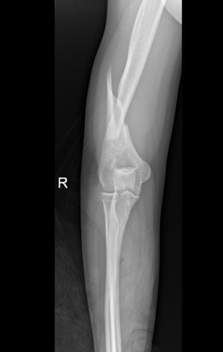 https://upload.orthobullets.com/cases/102067/ee1a4cf1-88c7-458f-ac34-e55cceaf92e8_fw1.jpg