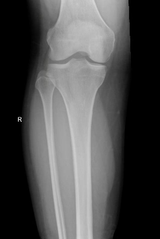 https://upload.orthobullets.com/cases/102668/ce4177b8-3ddb-413b-8802-72f50b05d78f_pre-op_xr_2.jpg