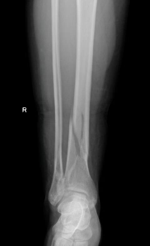https://upload.orthobullets.com/cases/102668/fe3471dc-6c4b-4fec-ba33-68666ab4c6b2_pre-op_xr_1.jpg