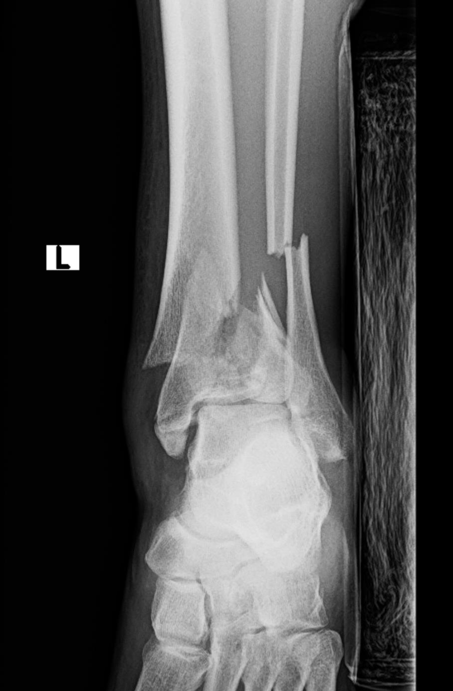https://upload.orthobullets.com/cases/102729/179ad9a1-dcf2-4b76-a2c8-dbedf25de2f9_a1.jpg