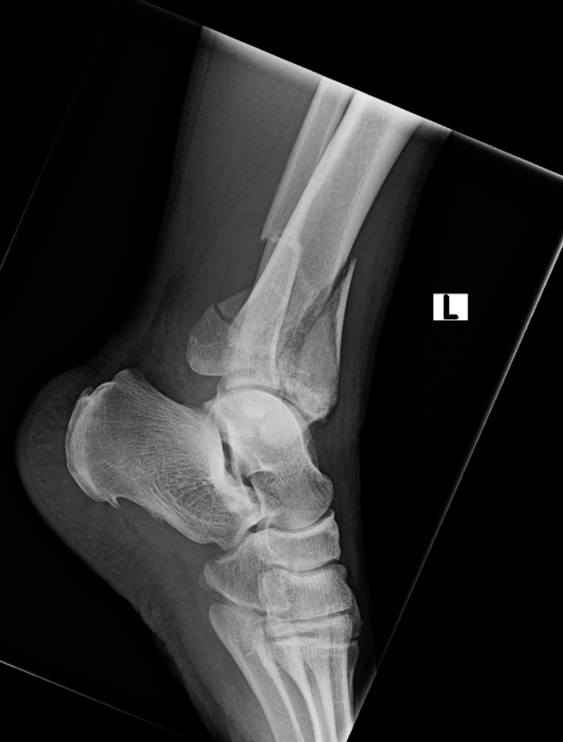 https://upload.orthobullets.com/cases/102729/984c9915-9000-4805-9676-2895e871d44b_a2.jpg