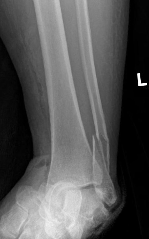 https://upload.orthobullets.com/cases/102735/js_a1.jpg