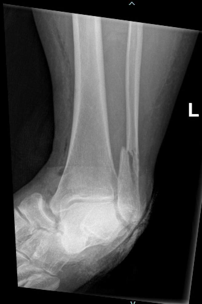 https://upload.orthobullets.com/cases/102735/js_a2.jpg