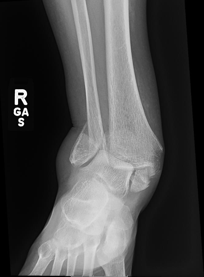 https://upload.orthobullets.com/cases/102742/bd4c69d8-da31-4f00-961a-a418ae6540a6_a2.jpg