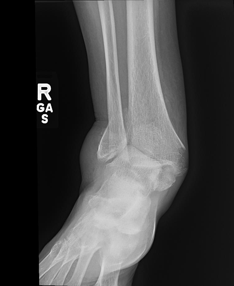 https://upload.orthobullets.com/cases/102742/d52abd13-213d-4fdf-bb91-6a22309d7984_a1.jpg