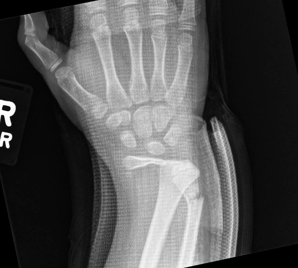 https://upload.orthobullets.com/cases/102745/b24ee5cd-300c-4b1f-ac25-fee2cc83fb47_pre-op_03.jpg