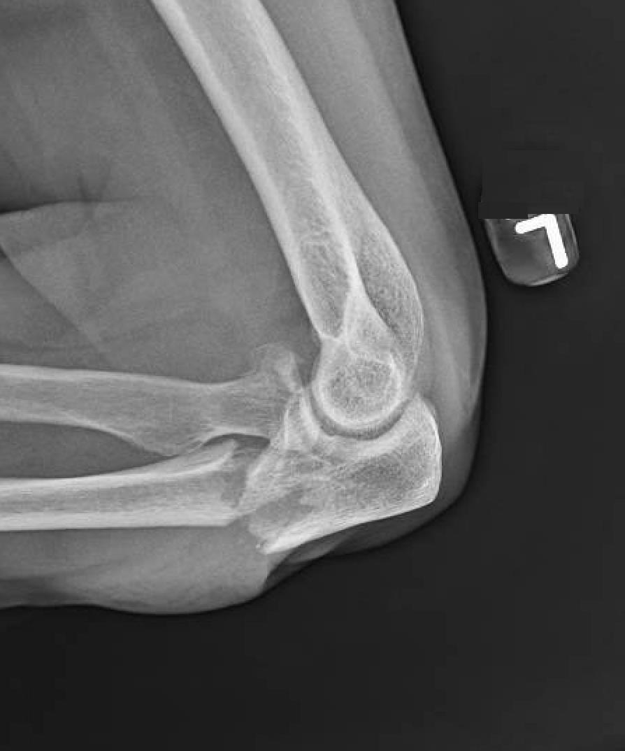 https://upload.orthobullets.com/cases/102754/a2.jpg
