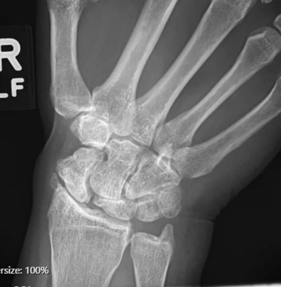https://upload.orthobullets.com/cases/102769/8ae889d6-6f4a-4e5e-a587-0549cb0a0b48_a1.jpg