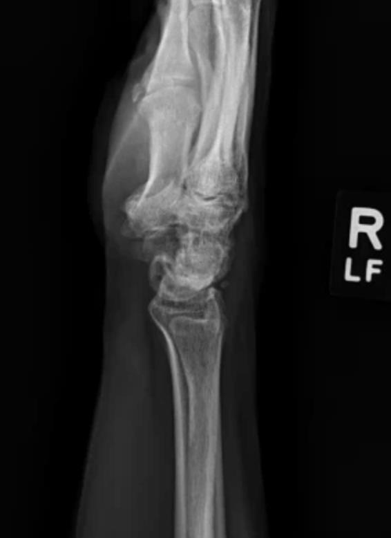 https://upload.orthobullets.com/cases/102769/c9d2c7df-d1eb-4207-a118-061dbeb59847_a2.jpg