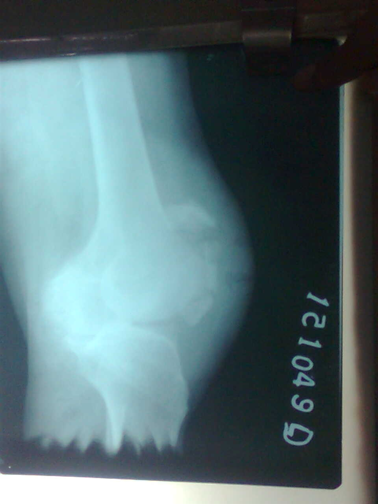Patella Fracture Trauma Orthobullets