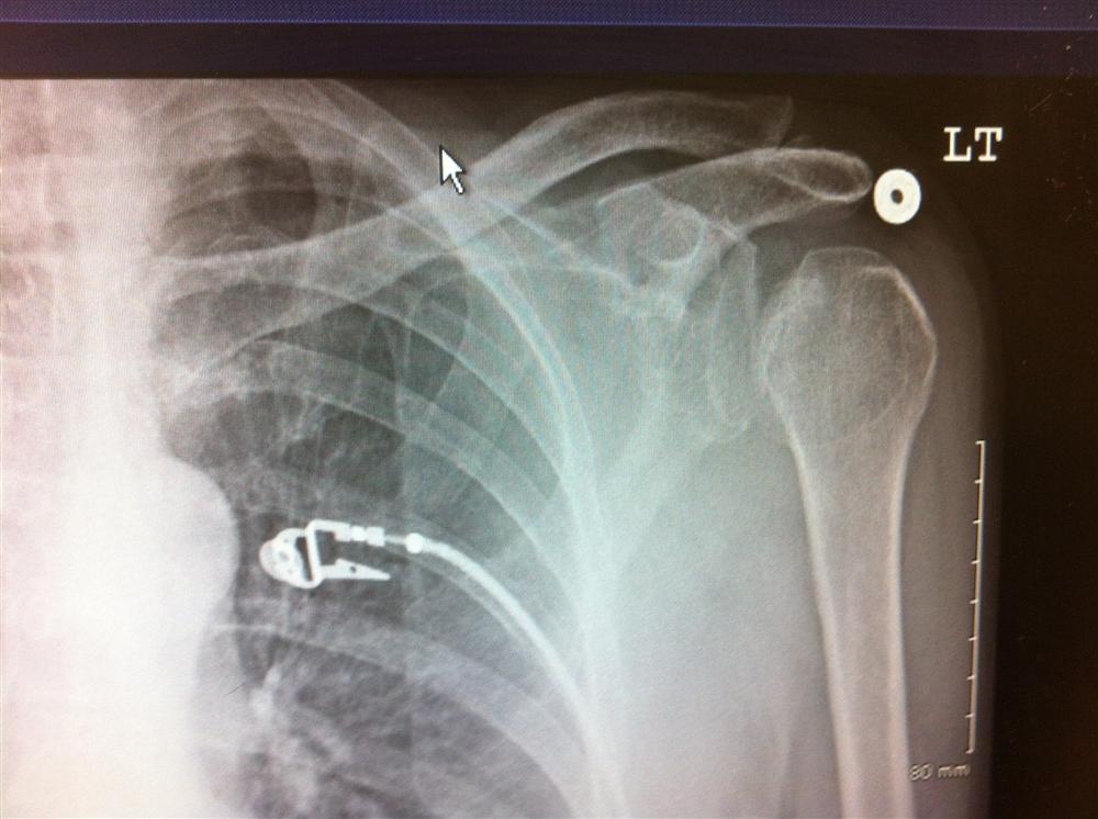 Posterior Shoulder Instability & Dislocation Shoulder & Elbow