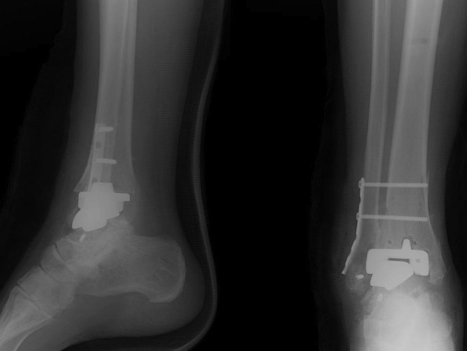 Ankle Arthrodesis Foot & Ankle Orthobullets