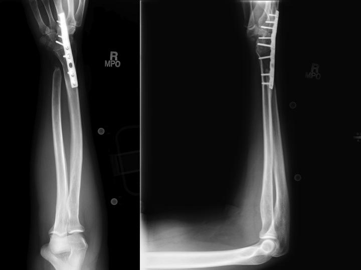 Wrist Arthritis Hand Orthobullets