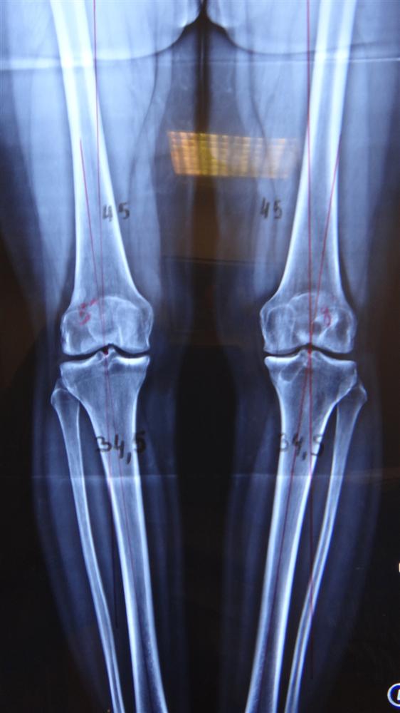 ACL Tear Knee & Sports Orthobullets