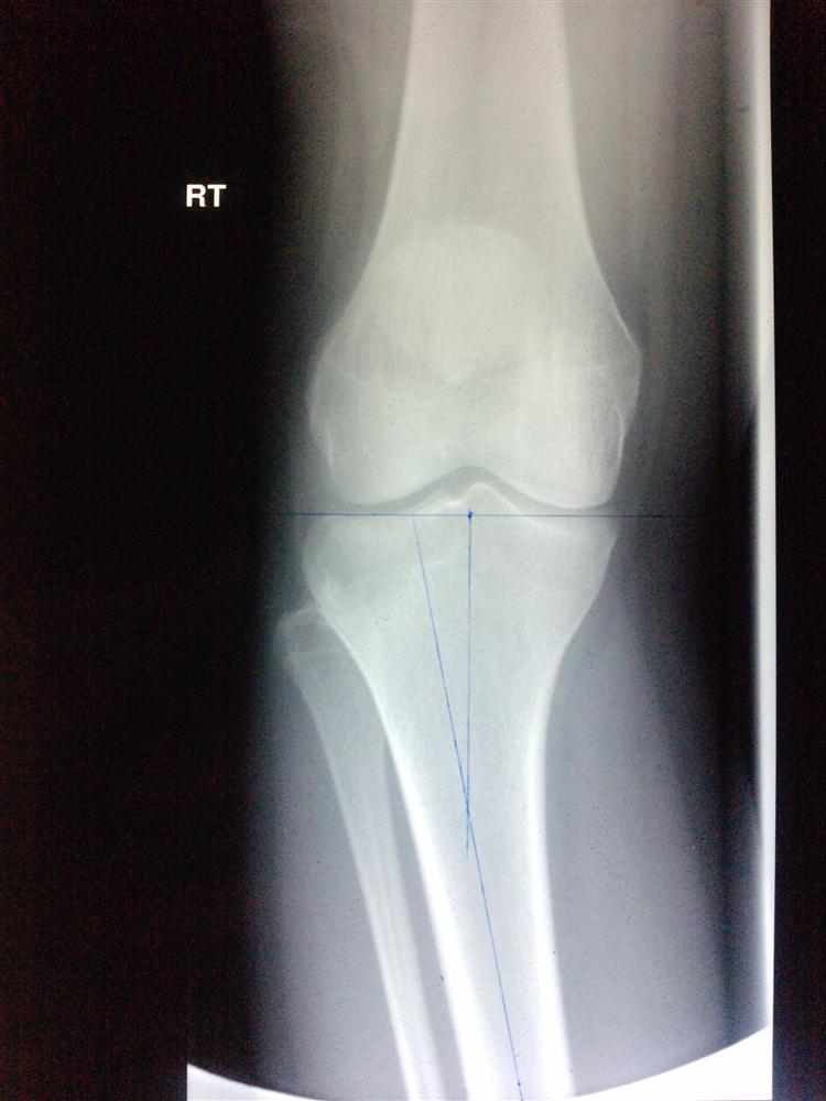 Genu Valgum (knocked knees) Pediatrics Orthobullets