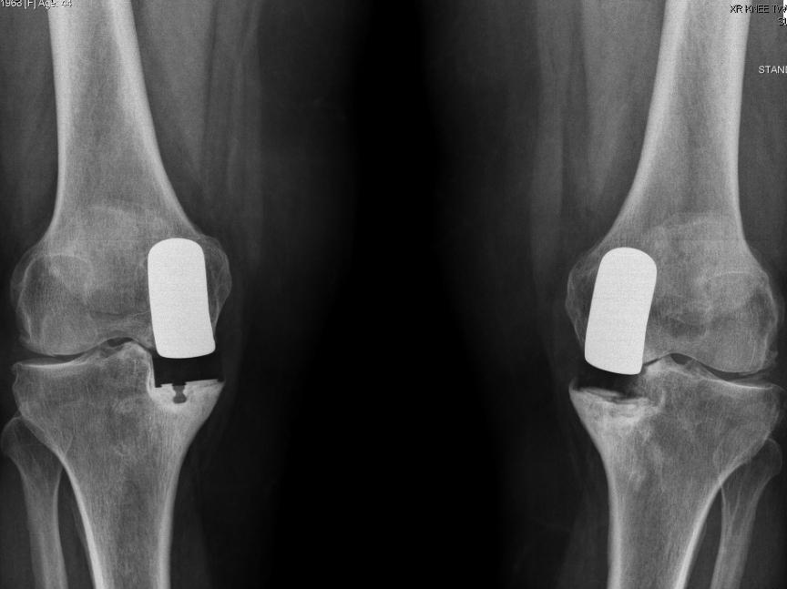 Knee Replacement Recon Orthobullets