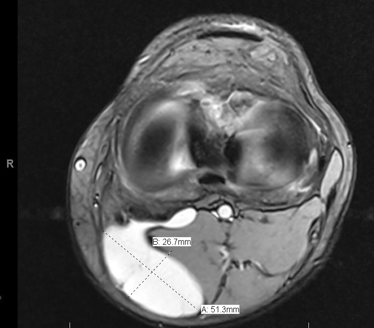 Meniscal Injury Knee & Sports Orthobullets