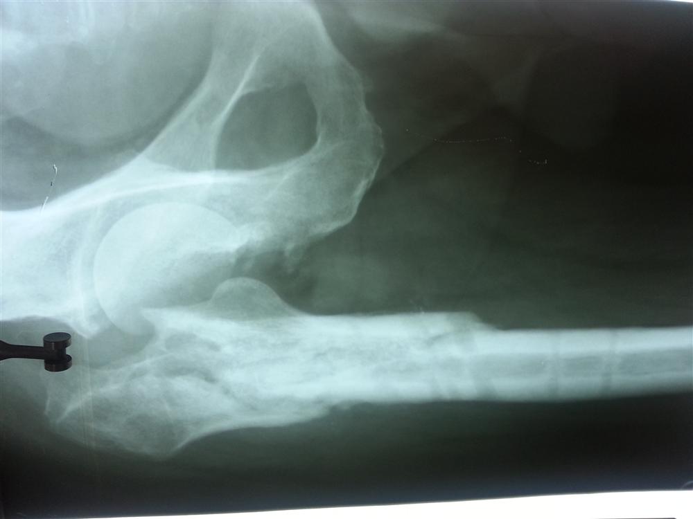 Prosthetic Joint Infection Recon Orthobullets