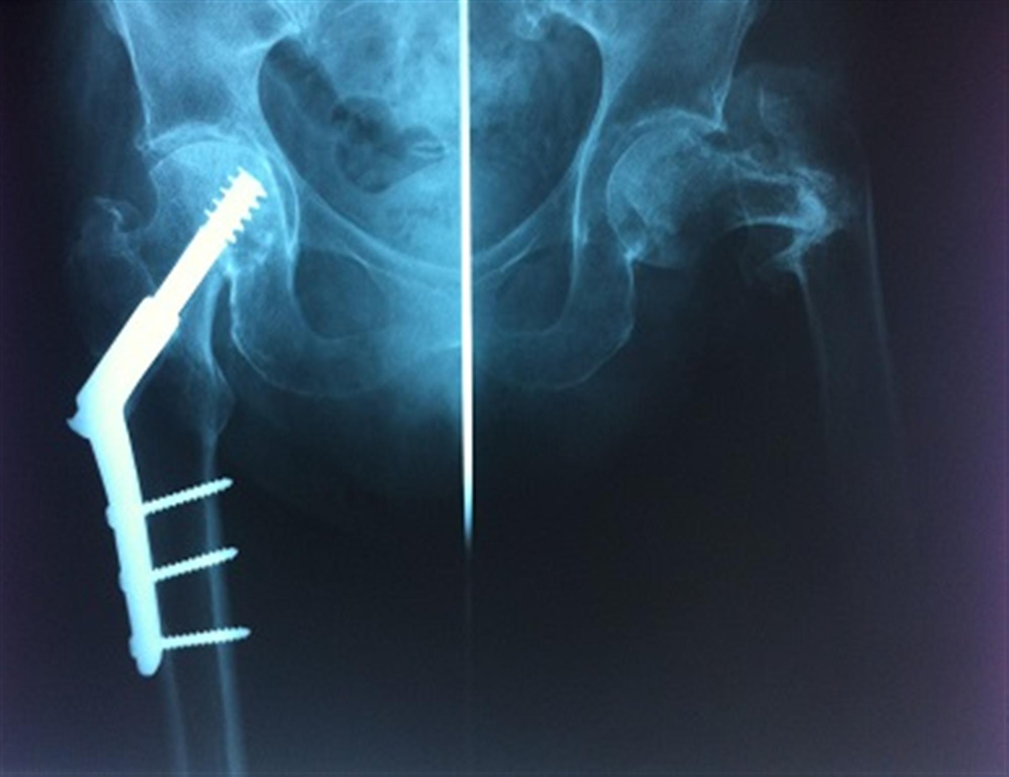 Femoral Neck Fractures Trauma