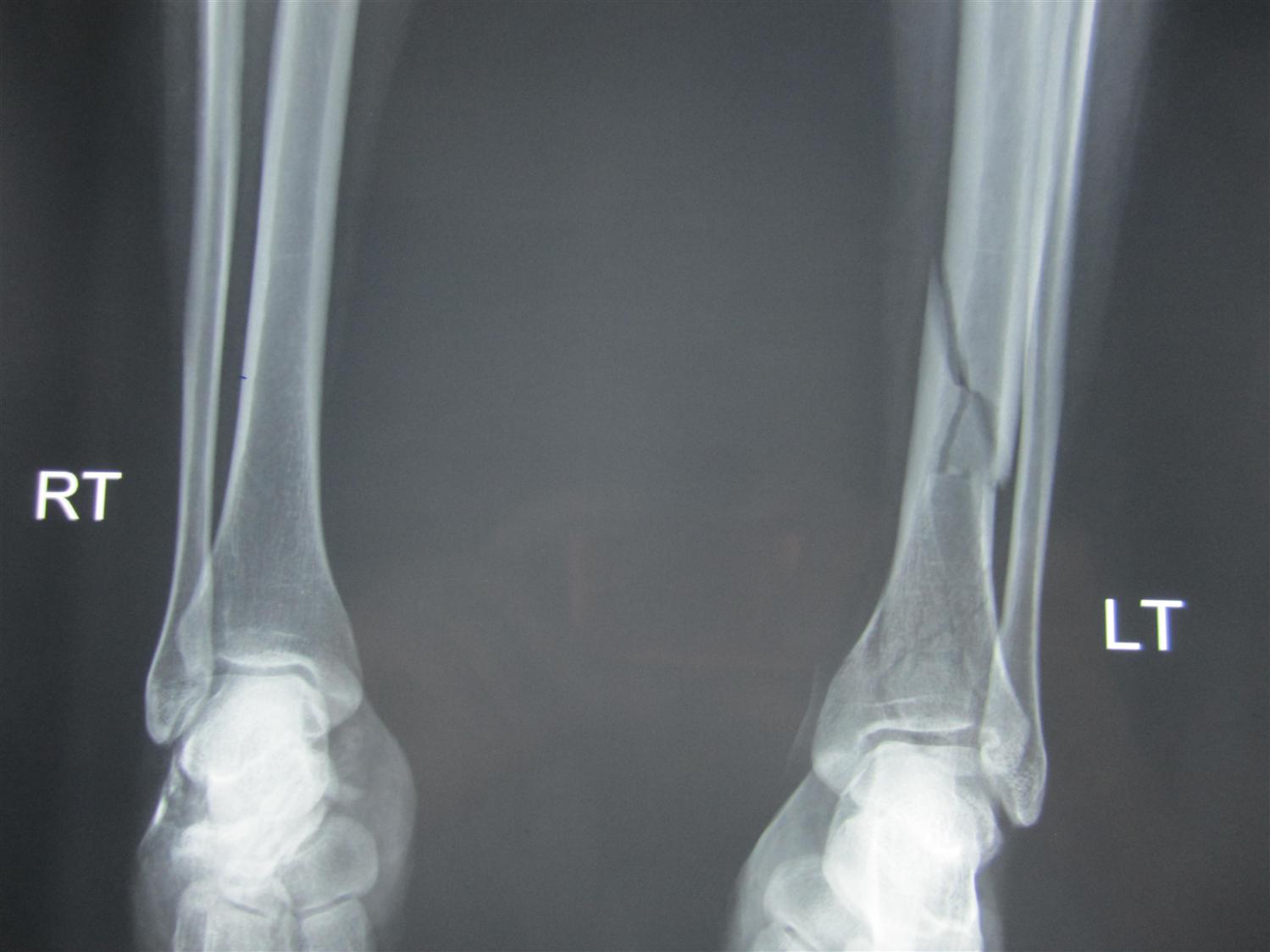 tibial plafond